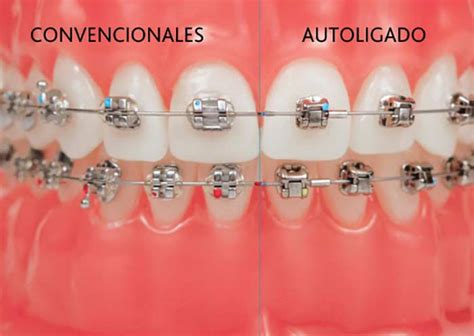 diferencias entre brackets metalicos y autoligables|diferencia entre bracketes y autoligados.